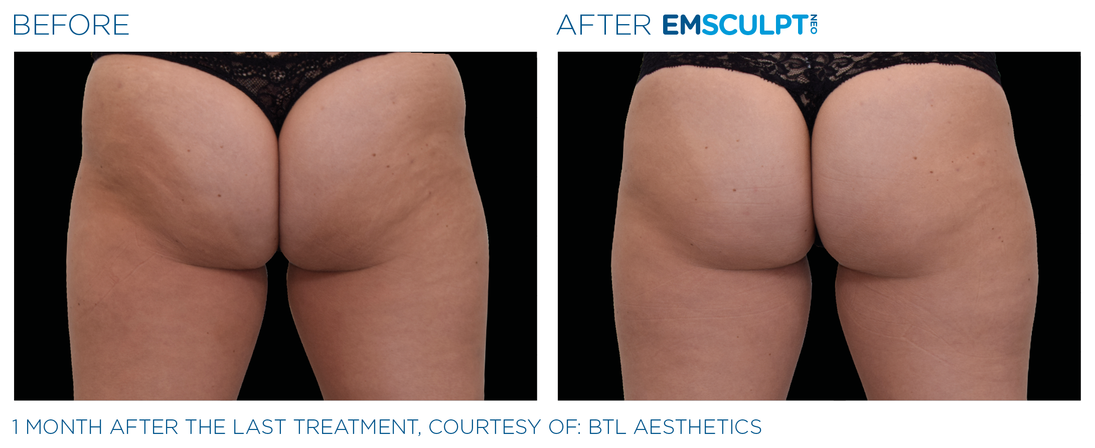 Emsculpt neo - female - Before and After - Glutes - Amaira Med spa