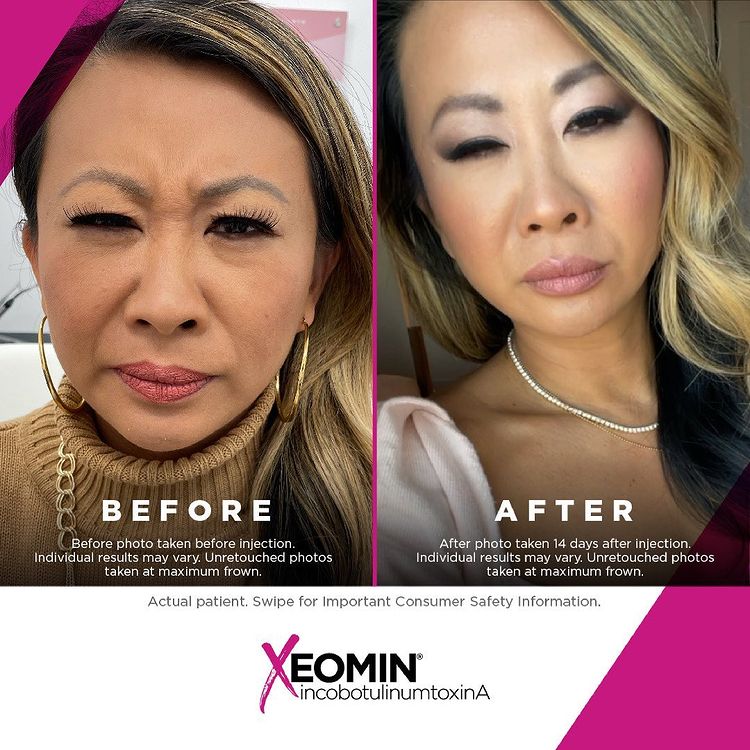 Amaira Med Spa, Treatment Xeomin, Before and after, E Las Olas Blvd. Ft. Lauderdale, FL