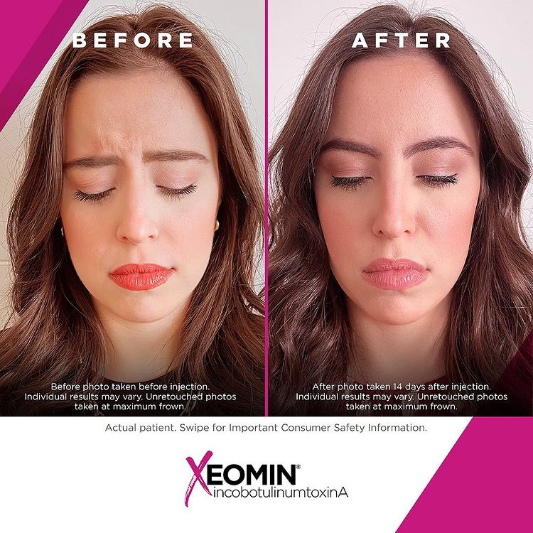 Amaira Med Spa, Before and after, Xeomin Treatment, E Las Olas Blvd. Ft. Lauderdale, FL