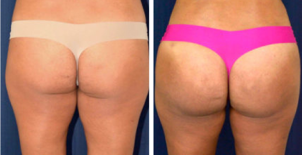 Glutes - The Best Morpheus8 Treatment In Fort Lauderdale - Amaira med spa