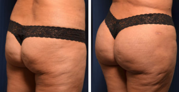 Before and after - Glutes - Emsculpt neo - Amaira med spa - The Best Emsculpt NEO In Fort Lauderdale