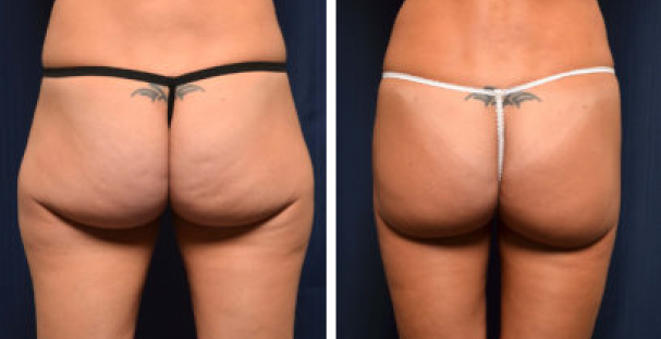 Glutes - Amaira med spa - radiofrequency - effectively - reduces cellulite