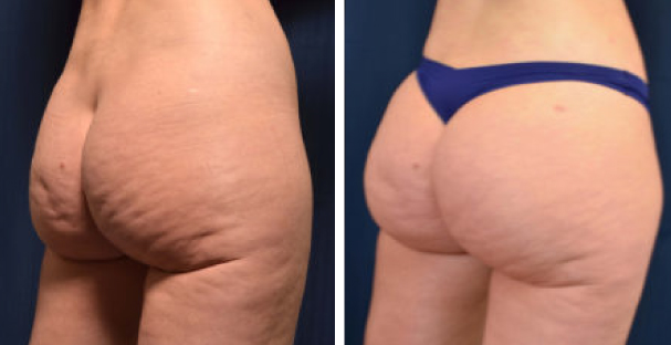 Amaira Med Spa - before and after women's buttocks - Las Olas Blvd. Ft. Lauderdale, FL