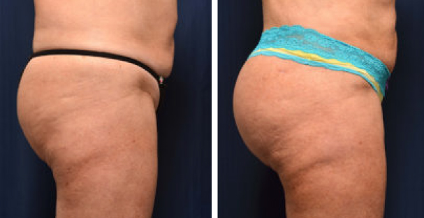 Amaira Med Spa - before and after women's buttocks lateral - Las Olas Blvd. Ft. Lauderdale, FL