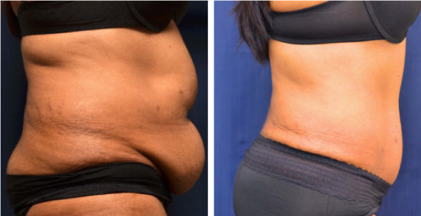 Amaira Med Spa - Before and after Tummy tuck - Fort lauderdale - Body