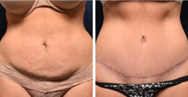 Before and after - Amaira med spa - Michael Frederick - Tummy tuck - The Best Tummy Tuck In Fort Lauderdale