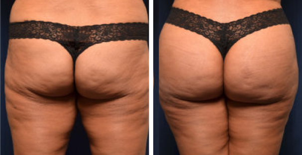 Before and after - Glutes - Emsculpt neo - Amaira med spa - The Best Emsculpt NEO In Fort Lauderdale