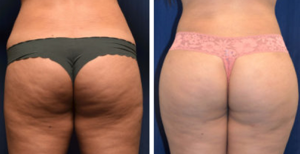 Before and after - Glutes - Amaira med spa