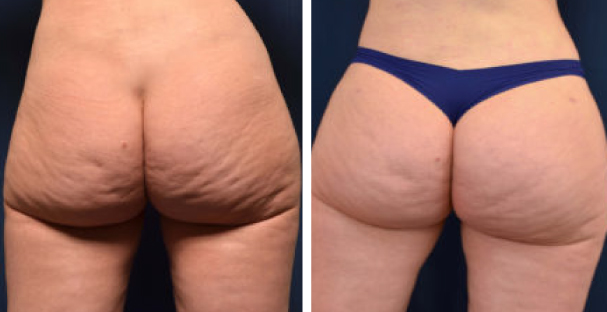 Before and after - Glutes - Amaira med spa - reduces cellulite - radiofrequency