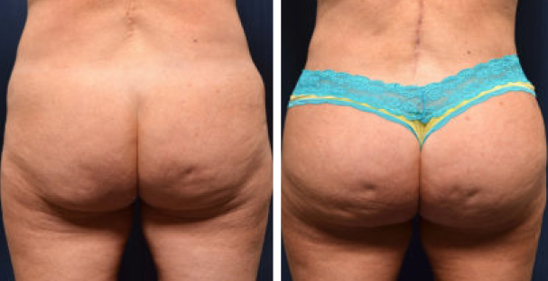 Before and after - Glutes - The best med spa in Fort lauderdale - Amaira med spa