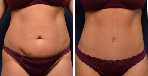 Before and after - Michael Frederick - Tummy tuck - The Best Tummy Tuck In Fort Lauderdale