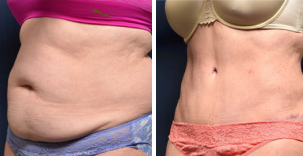 Dr. Frederick - Amaira Med spa - Abdominoplasty in Fort lauderdale - The best medical Spa
