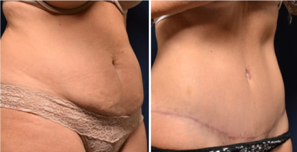 Abdominoplasty - Amaira med spa - Dr. Michael Frederick - The best abdominoplasty Fort lauderdale - Medical Spa