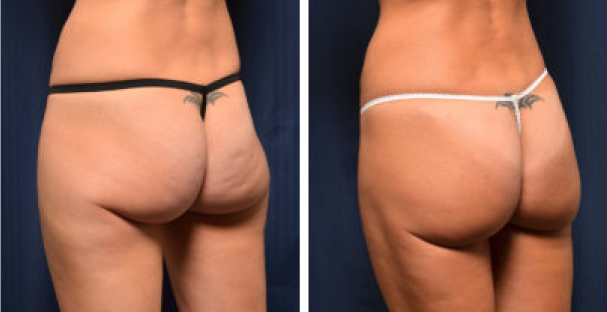 Glutes- reduces cellulite - Amaira med spa - The best treatment for Cellulite - Fort lauderdale