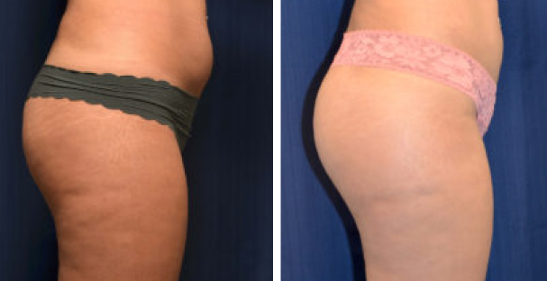 The best treatment for Cellulite - Amaira Med Spa - Fort lauderdale, fl - Glutes
