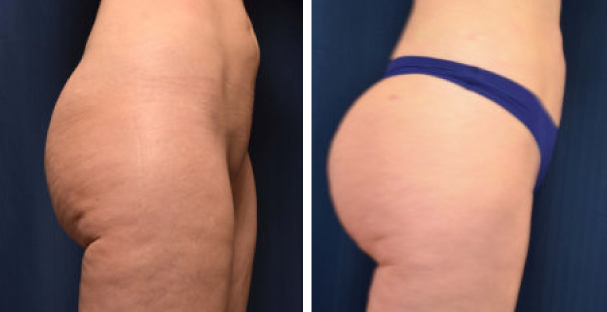 Amaira Med Spa - before and after women's buttocks lateral - Las Olas Blvd. Ft. Lauderdale, FL