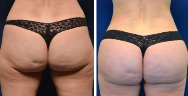Before and after - Amaira med spa - reduces cellulite - radiofrequency
