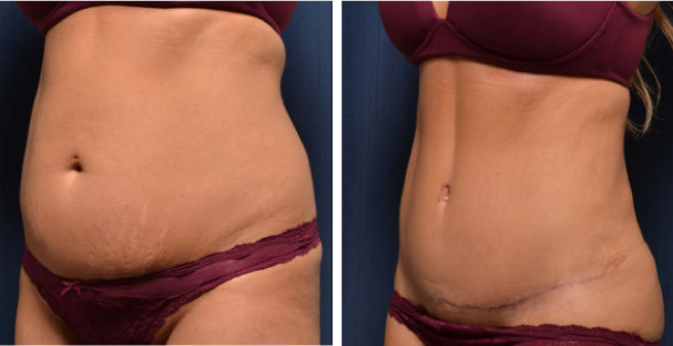 Amaira Med Spa - before and after tummy tuck for women waist circumference reduction - Las Olas Blvd. Ft. Lauderdale, FL