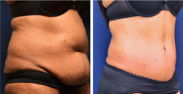Amaira Med Spa - before and after tummy tuck for women waist circumference reduction - Las Olas Blvd. Ft. Lauderdale, FL
