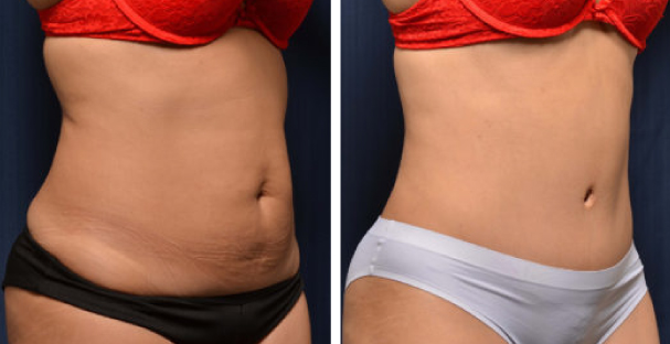 Before and after - Amaira med spa - Dr. Michael Frederick - Tummy tuck - The Best Tummy Tuck In Fort Lauderdale