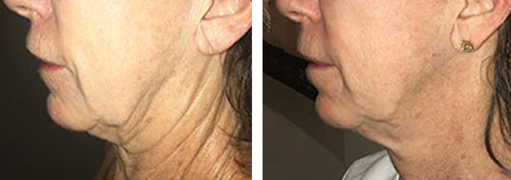 Before-and-After-Morpheus8-Amaira Med Spa