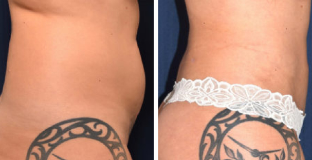Amaira Med Spa - before and after tummy tuck for women tattos - Las Olas Blvd. Ft. Lauderdale, FL