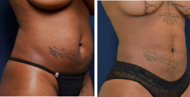 Amaira Med Spa - before and after tummy tuck for women tattos - Las Olas Blvd. Ft. Lauderdale, FL