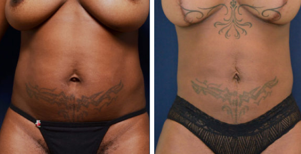 Amaira Med Spa - before and after tummy tuck for women flat belly tattos - Las Olas Blvd. Ft. Lauderdale, FL