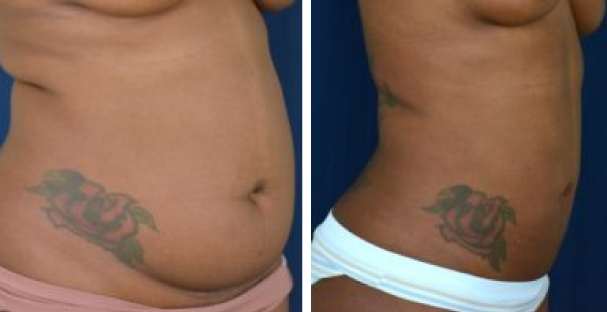 Amaira Med Spa - before and after tummy tuck for women flat belly and big belly tattos - Las Olas Blvd. Ft. Lauderdale, FL