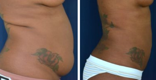 Amaira Med Spa - before and after tummy tuck for women flat belly and big belly - Las Olas Blvd. Ft. Lauderdale, FL