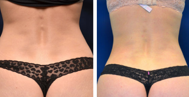 Amaira Med Spa - before and after aesthetic female back delineation - Las Olas Blvd. Ft. Lauderdale, FL