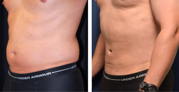 Amaira Med Spa - before and after tummy tuck for men waist circumference reduction - Las Olas Blvd. Ft. Lauderdale, FL