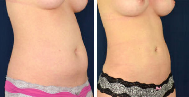 Amaira Med Spa - before and after tummy tuck for women waist circumference reduction lateral - Las Olas Blvd. Ft. Lauderdale, FL