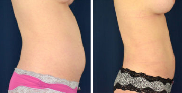 Amaira Med Spa - before and after tummy tuck for women waist circumference reduction lateral - Las Olas Blvd. Ft. Lauderdale, FL