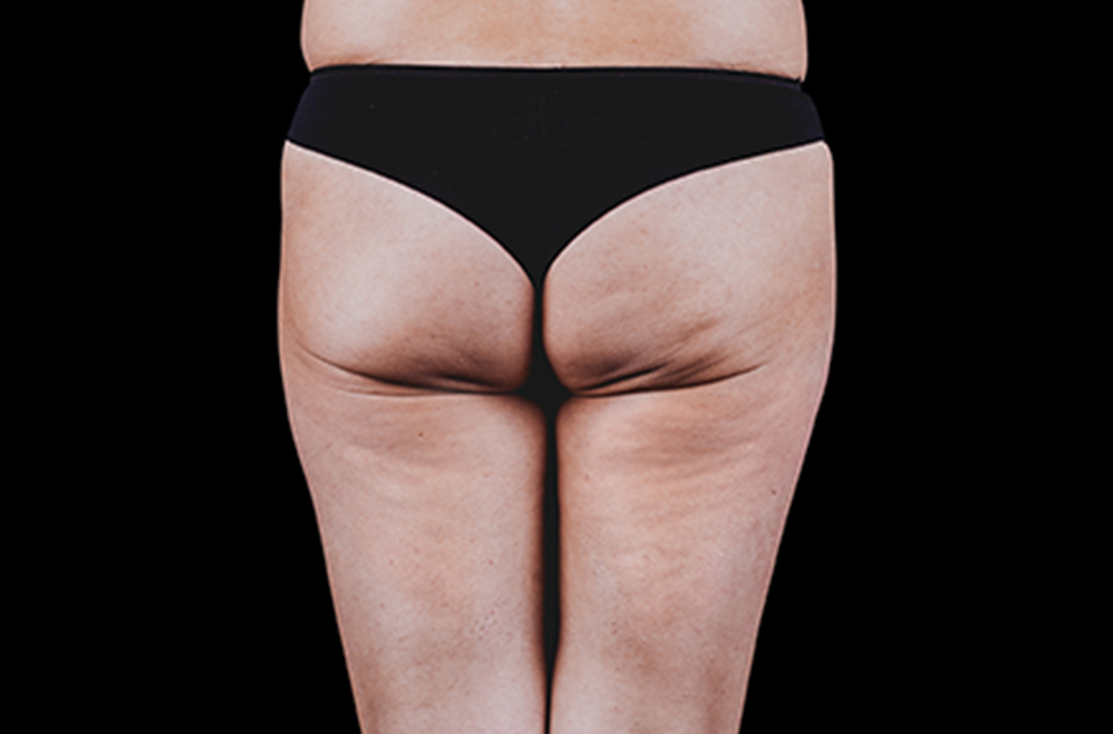 Amaira Med Spa - affected women's buttocks - Las Olas Blvd. Ft. Lauderdale, FL
