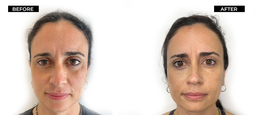 Amaira Med Spa, Treatment Threads Lift, Before and after, E Las Olas Blvd. Ft. Lauderdale, FL