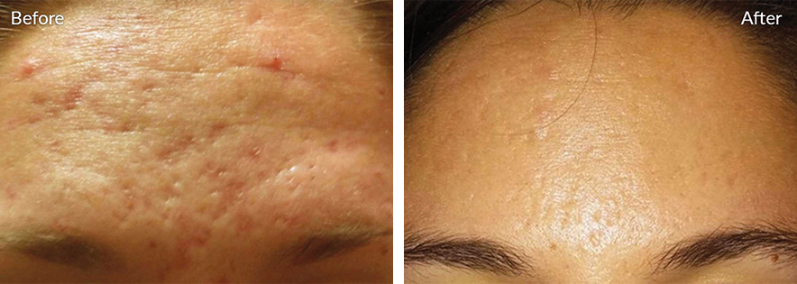 Amaira Med Spa -before and after aesthetic changes in the forehead - Las Olas Blvd. Ft. Lauderdale, FL