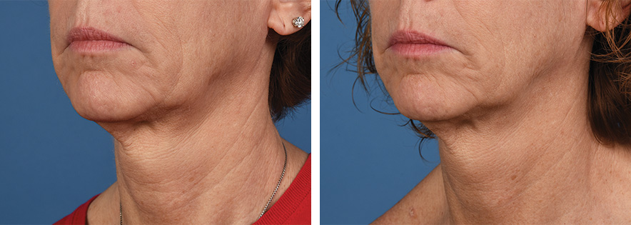 Amaira Med Spa - before and after wrinkle changes on the chin - Las Olas Blvd. Ft. Lauderdale, FL