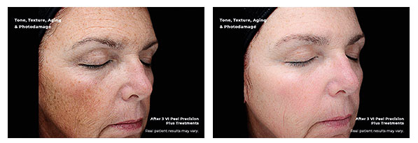Amaira Med Spa, Before-and-After-Photodamage, E Las Olas Blvd. Ft. Lauderdale, FL