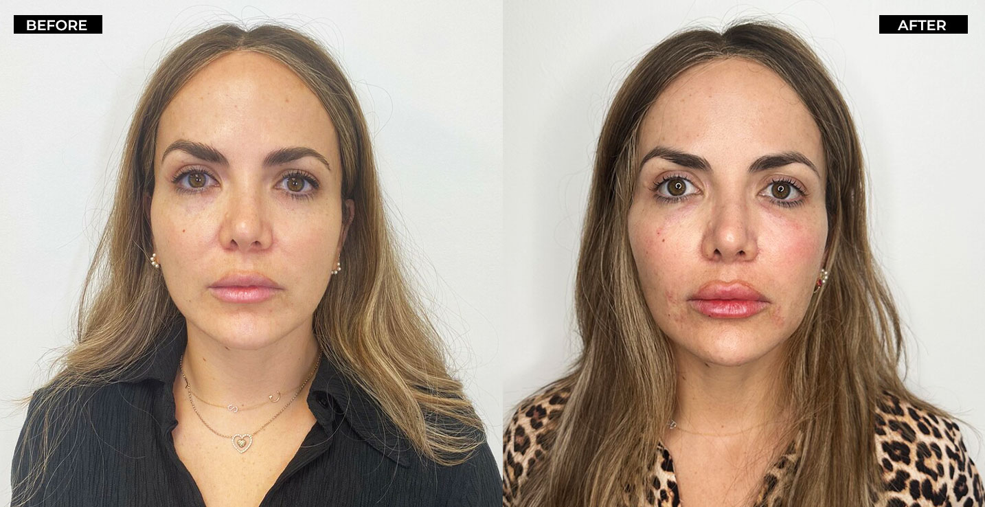 Thread Lift, Before and after, Amaira Med Spa, Treatment, E Las Olas Blvd. Ft. Lauderdale, FL