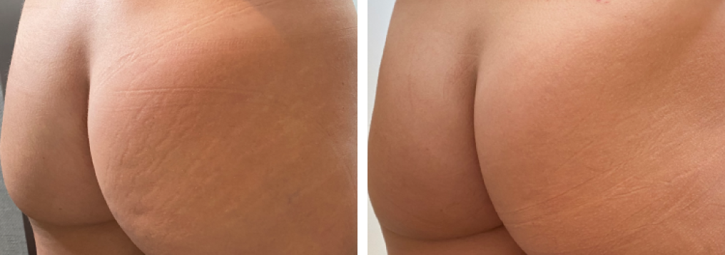 Morpheus8 - Amaira Med spa - Fort lauderdale - Before and after - Glutes