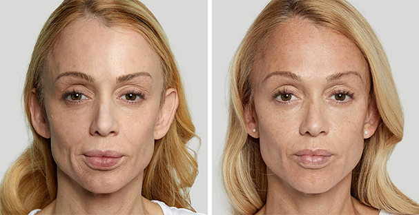 Amaira Med Spa, before and after, Treatment Sculptra, landing page