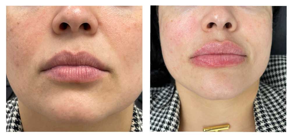 Amaira Med Spa - Before and after - Lip Fillers - woman
