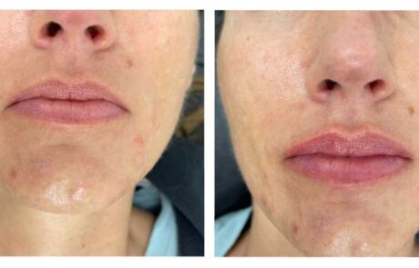 Amaira Med Spa - Before and after - Lip Fillers - woman