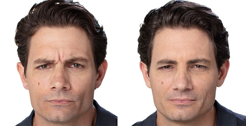 Before and After-Botox-Men-Amaira-Med-Spa