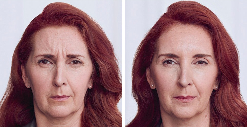Before and After-Botox-Women-Full face-Amaira-Med-Spa