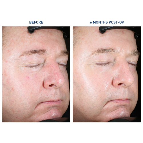 bpc 157 rosacea AYON/Renuvion