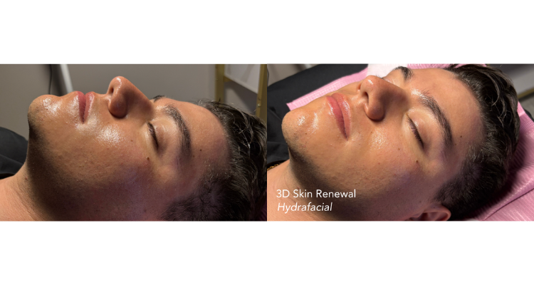 HydraFacial in Fort Lauderdale, FL
