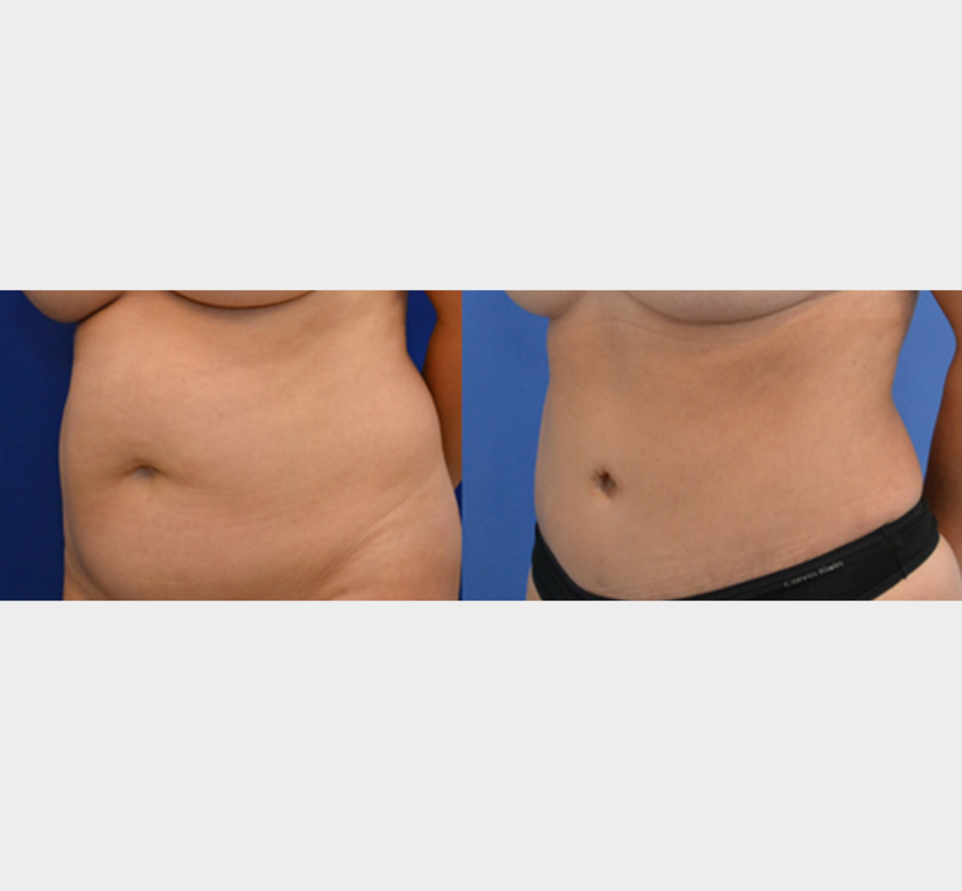 Tummy tuck before and after side view abdominal contour