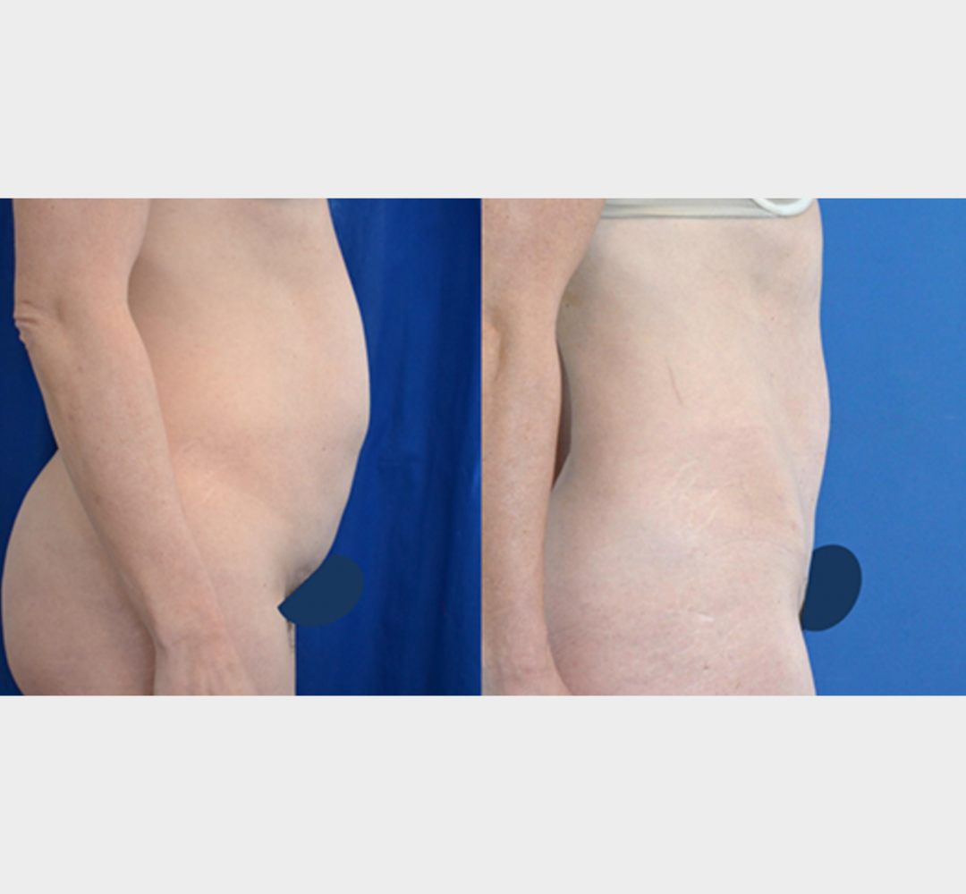 Female tummy tuck before and after front view abdomen